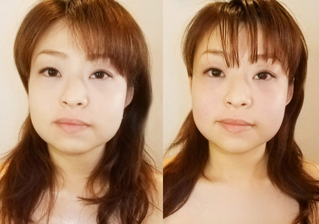 小顔整顔ビフォーアフター